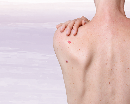 Câncer de pele: medidas preventivas seguem sendo essenciais durante o inverno