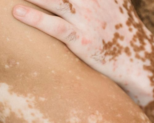 Dia Mundial do Vitiligo: quais os sintomas da doença que afeta mais de 1 milhão de brasileiros