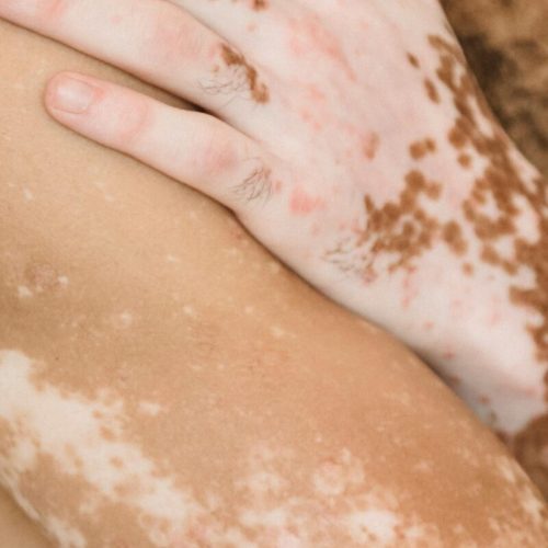 Dia Mundial do Vitiligo: quais os sintomas da doença que afeta mais de 1 milhão de brasileiros