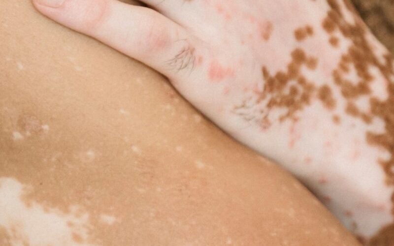 Dia Mundial do Vitiligo: quais os sintomas da doença que afeta mais de 1 milhão de brasileiros